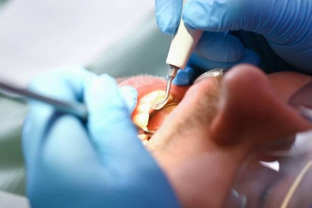 Best Emergency Wisdom Tooth Extraction in West Brownsville, PA